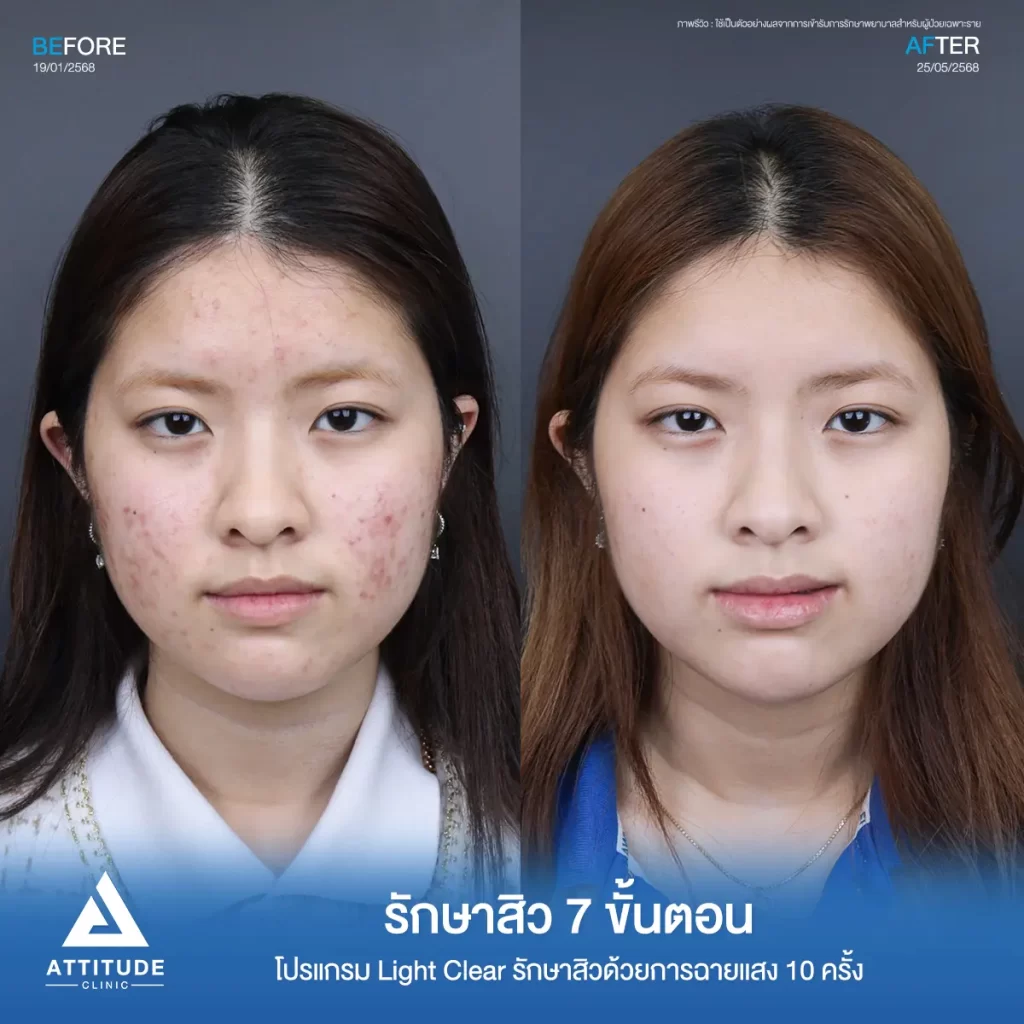 รีวิวรักษาสิวจินจิน โปรแกรม Light Clear รักษาสิวด้วยการฉายแสง จำนวน 10 ครั้งที่ Attitude Clinic