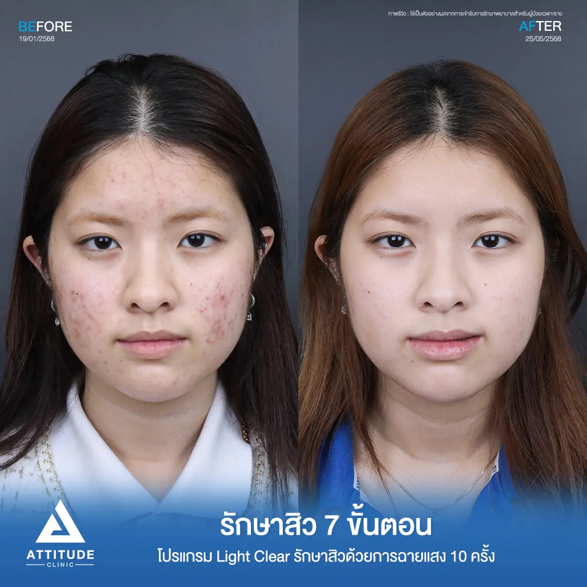 รีวิวรักษาสิวจินจิน โปรแกรม Light Clear รักษาสิวด้วยการฉายแสง จำนวน 10 ครั้งที่ Attitude Clinic