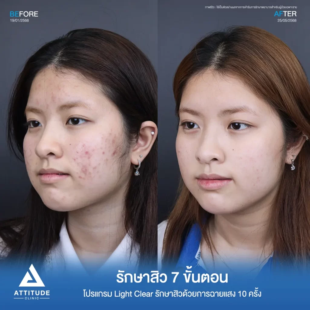 รีวิวรักษาสิวจินจิน โปรแกรม Light Clear รักษาสิวด้วยการฉายแสง จำนวน 10 ครั้งที่ Attitude Clinic