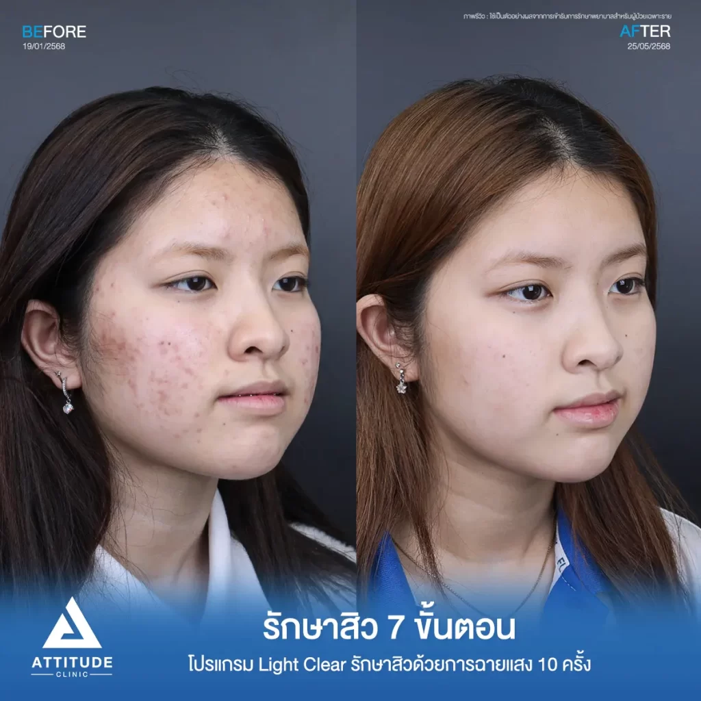 รีวิวรักษาสิวจินจิน โปรแกรม Light Clear รักษาสิวด้วยการฉายแสง จำนวน 10 ครั้งที่ Attitude Clinic