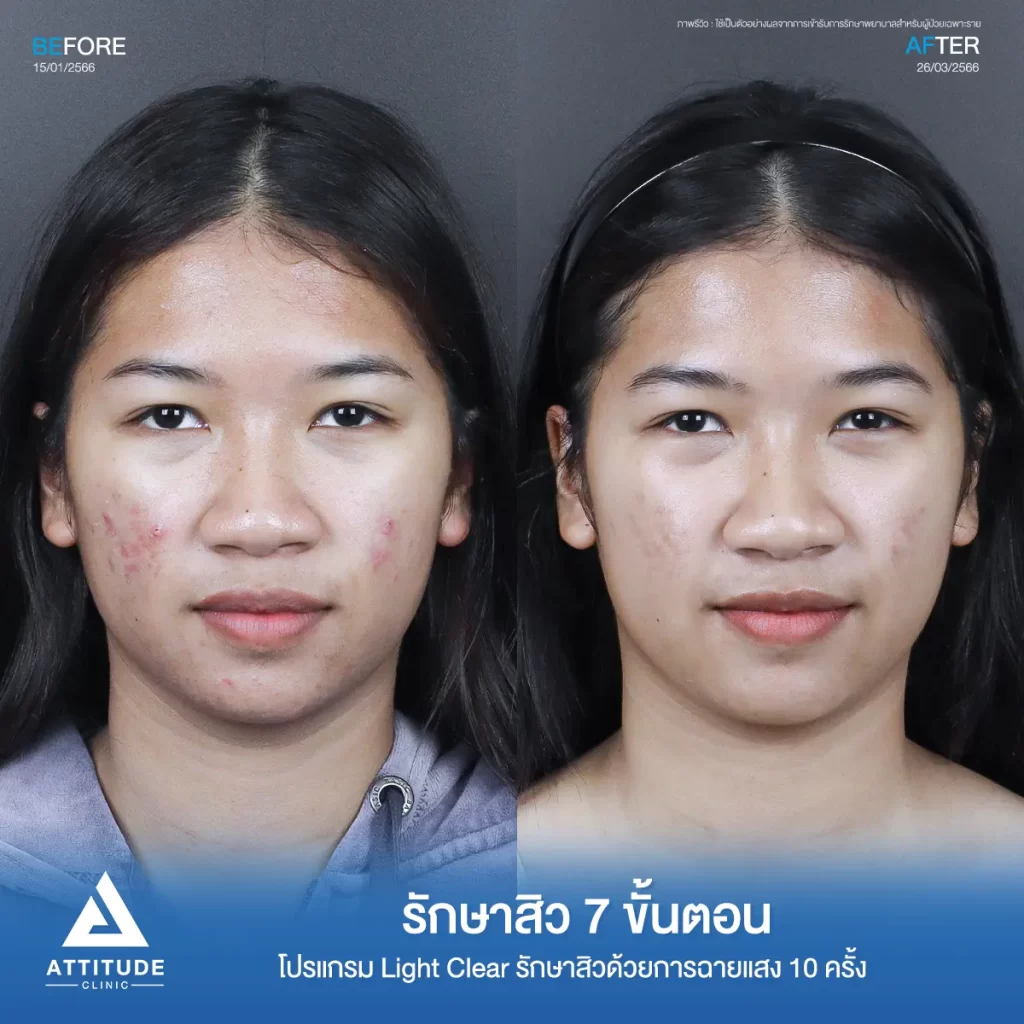 รีวิวรักษาสิวพี่เจนนี่ โปรแกรม Light Clear รักษาสิวด้วยการฉายแสง จำนวน 10 ครั้งที่ Attitude Clinic