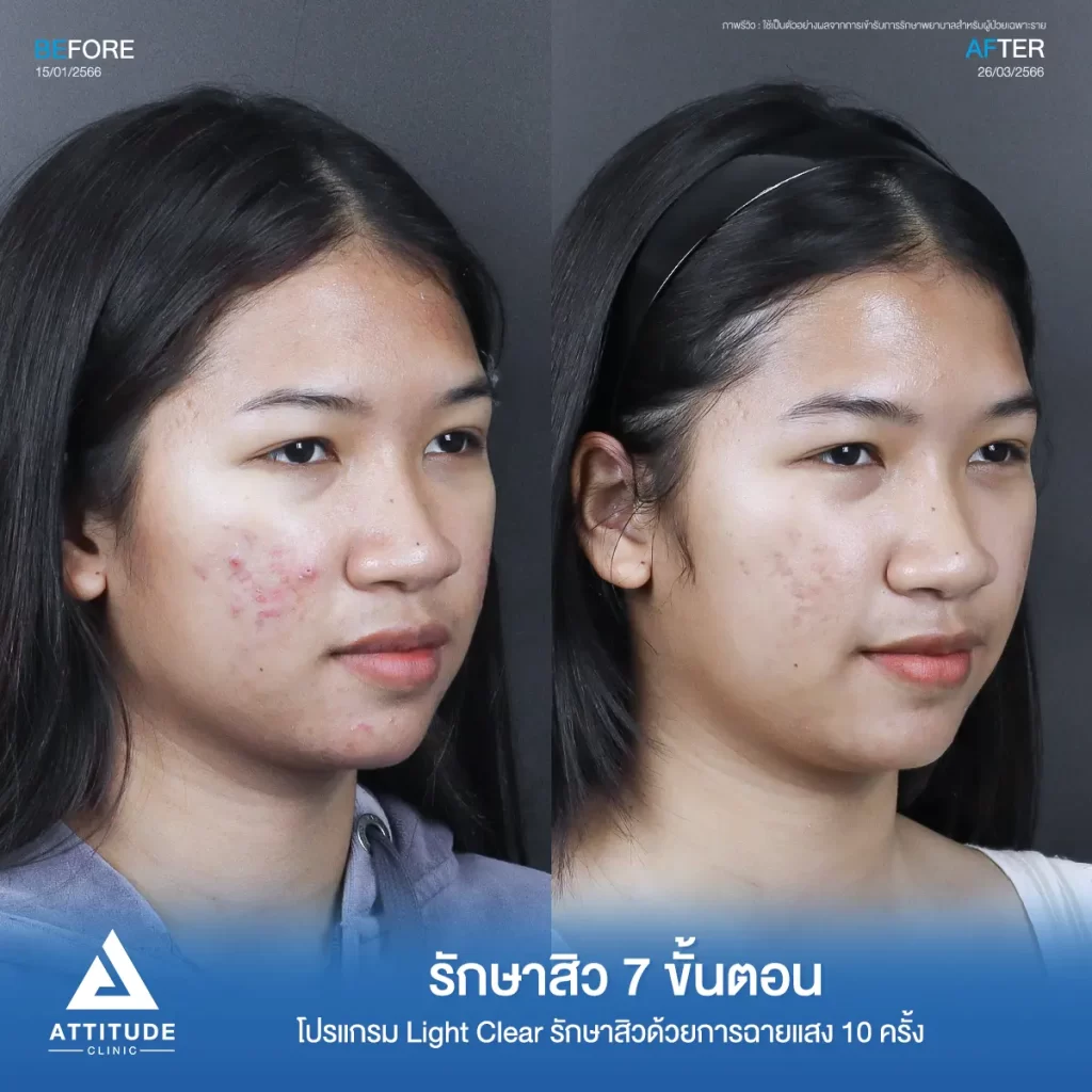 รีวิวรักษาสิวพี่เจนนี่ โปรแกรม Light Clear รักษาสิวด้วยการฉายแสง จำนวน 10 ครั้งที่ Attitude Clinic