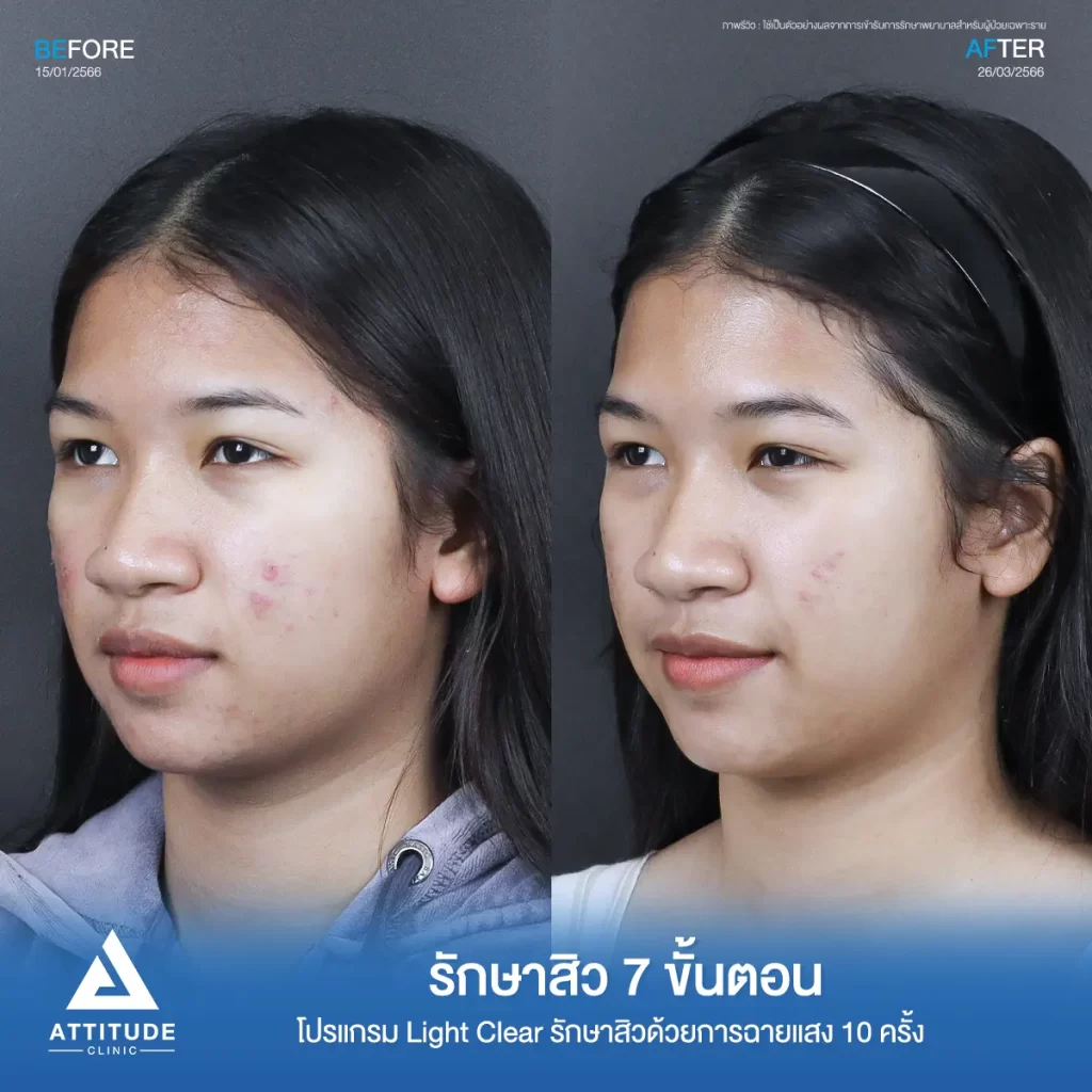 รีวิวรักษาสิวพี่เจนนี่ โปรแกรม Light Clear รักษาสิวด้วยการฉายแสง จำนวน 10 ครั้งที่ Attitude Clinic