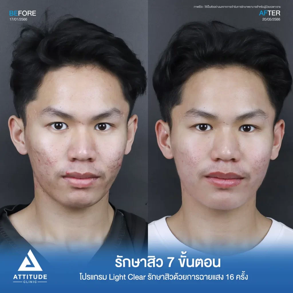 รีวิวรักษาสิวพี่คิมย้ง โปรแกรม Light Clear รักษาสิวด้วยการฉายแสง จำนวน 16 ครั้งที่ Attitude Clinic