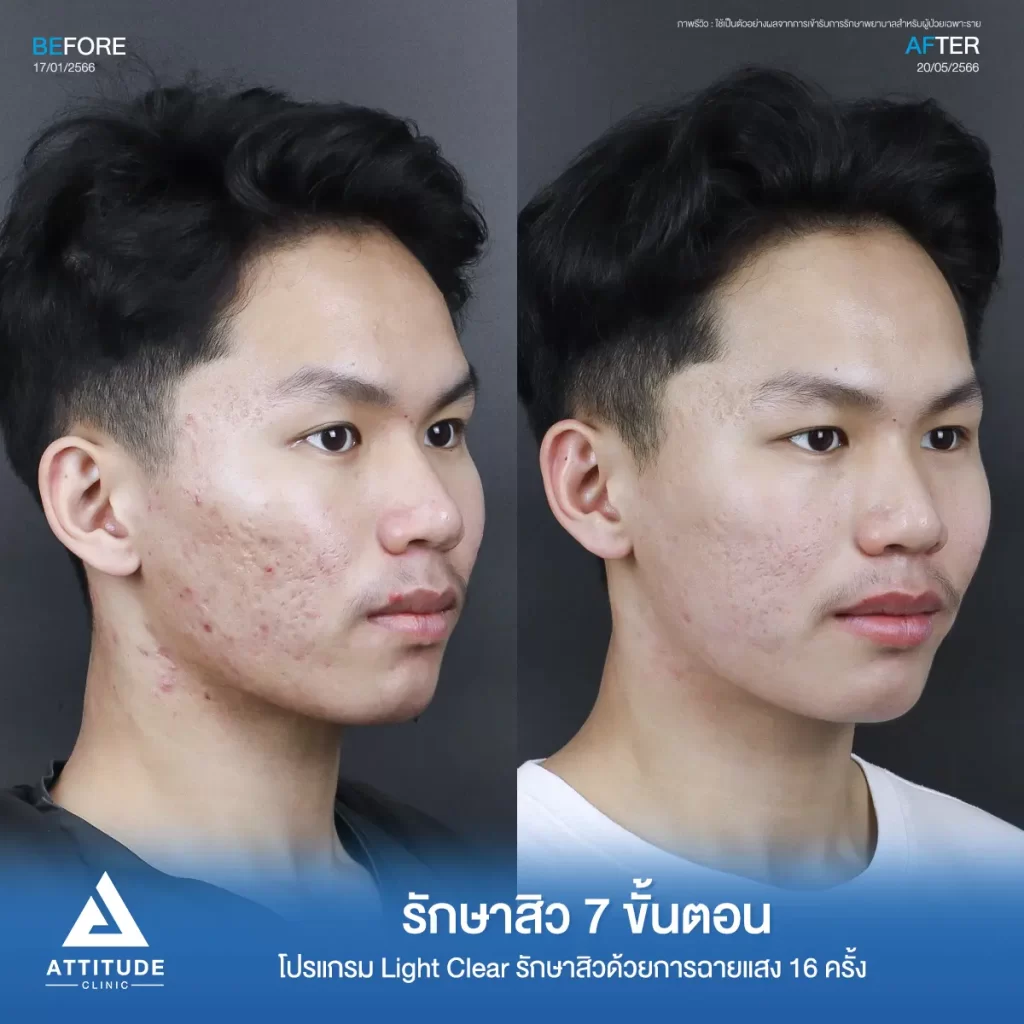 รีวิวรักษาสิวพี่คิมย้ง โปรแกรม Light Clear รักษาสิวด้วยการฉายแสง จำนวน 16 ครั้งที่ Attitude Clinic
