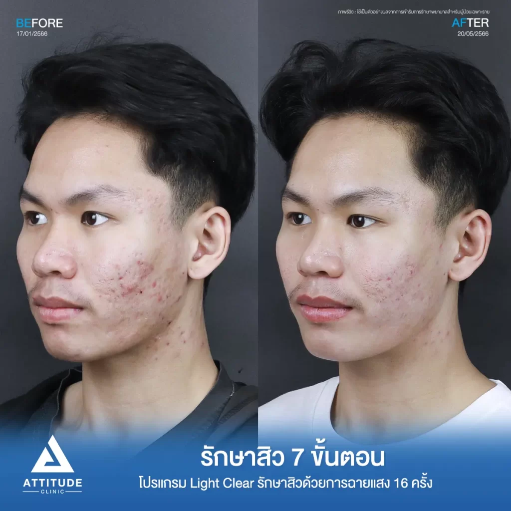 รีวิวรักษาสิวพี่คิมย้ง โปรแกรม Light Clear รักษาสิวด้วยการฉายแสง จำนวน 16 ครั้งที่ Attitude Clinic