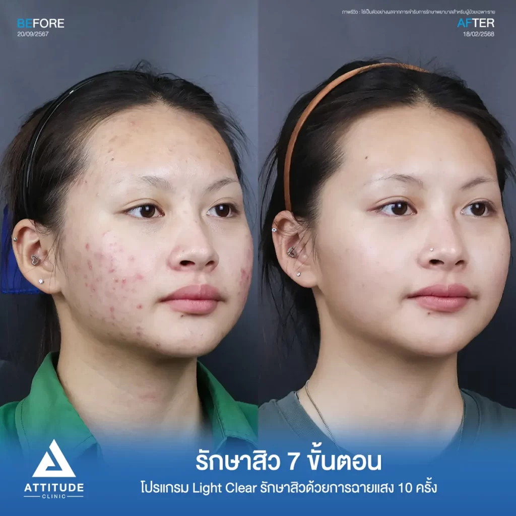 รีวิวรักษาสิวพี่น้ำหวาน โปรแกรม Light Clear รักษาสิวด้วยการฉายแสง จำนวน 10 ครั้งที่ Attitude Clinic