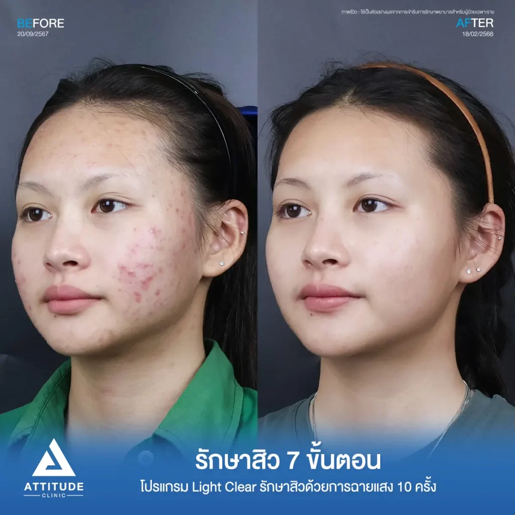 รีวิวรักษาสิวพี่น้ำหวาน โปรแกรม Light Clear รักษาสิวด้วยการฉายแสง จำนวน 10 ครั้งที่ Attitude Clinic