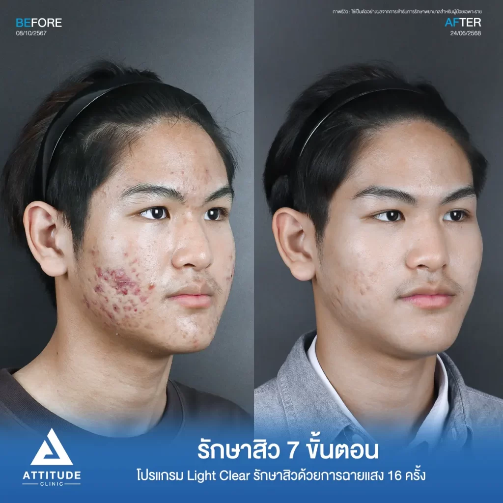 รีวิวรักษาสิวพี่นัท โปรแกรม Light Clear รักษาสิวด้วยการฉายแสง จำนวน 16 ครั้งที่ Attitude Clinic