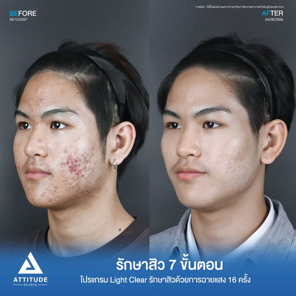 รีวิวรักษาสิวพี่นัท โปรแกรม Light Clear รักษาสิวด้วยการฉายแสง จำนวน 16 ครั้งที่ Attitude Clinic