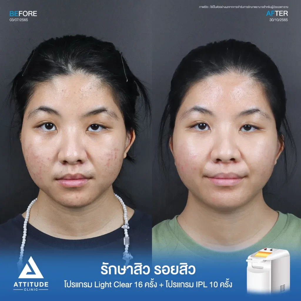 รีวิวรักษาสิวพี่นันท์นภัส โปรแกรม Light Clear รักษาสิวด้วยการฉายแสง จำนวน 16 ครั้ง ต่อด้วยโปรแกรม IPL รักษารอยสิว จำนวน 10 ครั้งที่ Attitude Clinic