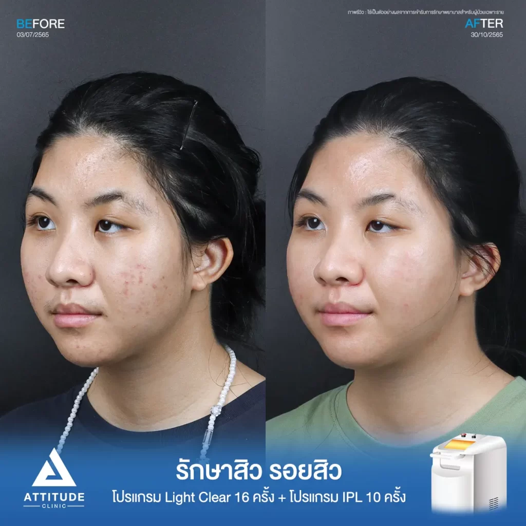รีวิวรักษาสิวพี่นันท์นภัส โปรแกรม Light Clear รักษาสิวด้วยการฉายแสง จำนวน 16 ครั้ง ต่อด้วยโปรแกรม IPL รักษารอยสิว จำนวน 10 ครั้งที่ Attitude Clinic