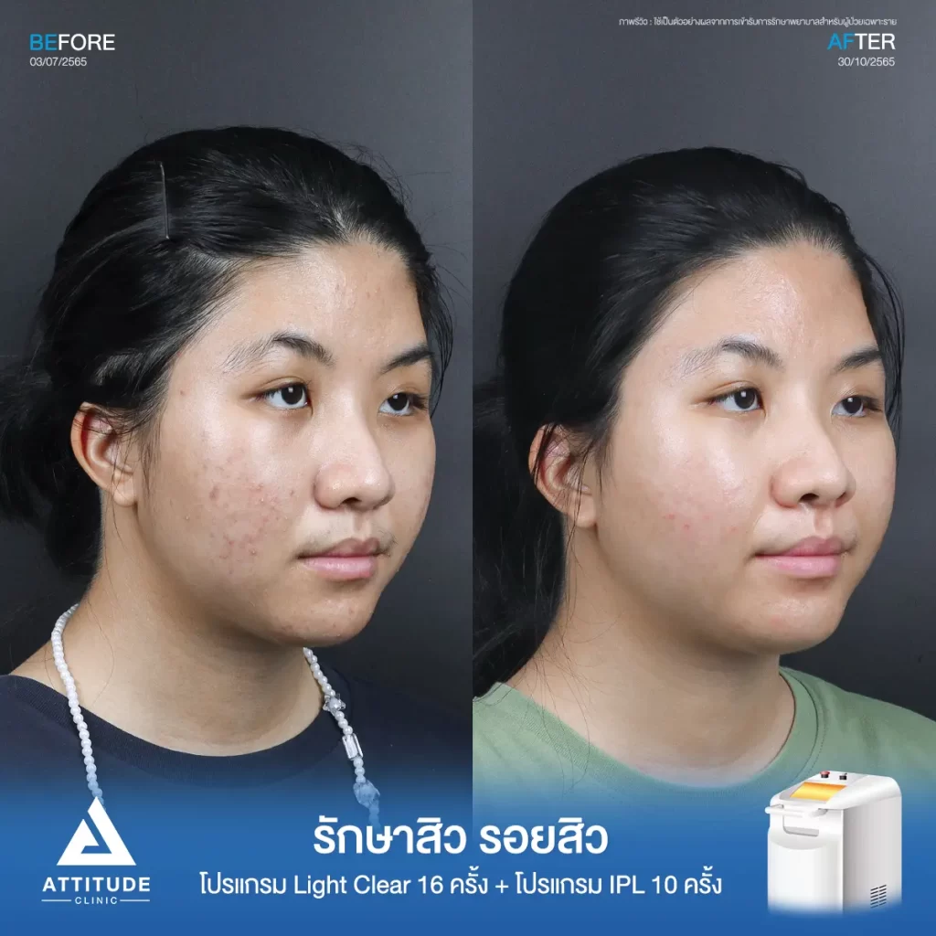 รีวิวรักษาสิวพี่นันท์นภัส โปรแกรม Light Clear รักษาสิวด้วยการฉายแสง จำนวน 16 ครั้ง ต่อด้วยโปรแกรม IPL รักษารอยสิว จำนวน 10 ครั้งที่ Attitude Clinic