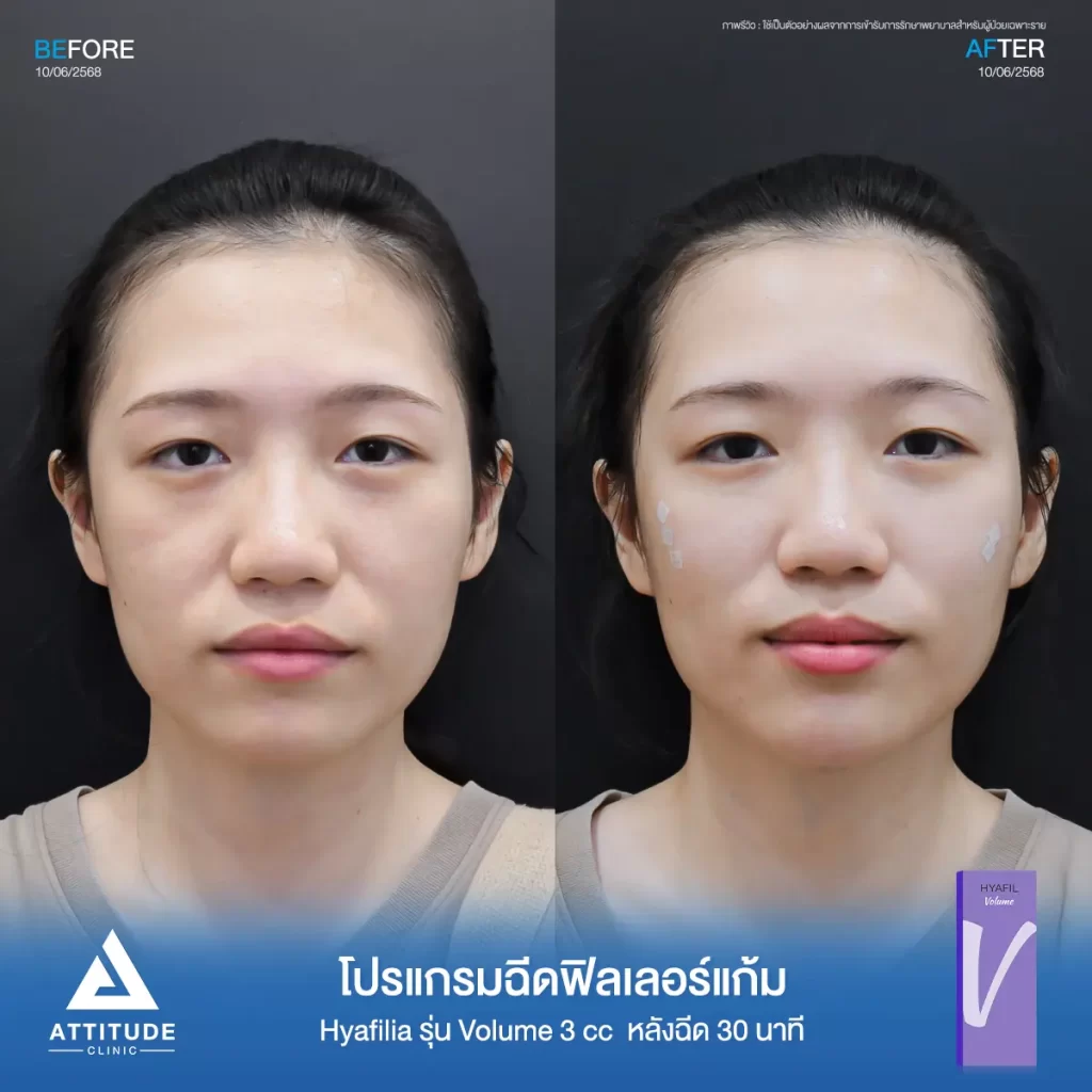 รีวิวโปรแกรมฉีดฟิลเลอร์แก้มพี่แพร Hya รุ่น V จำนวน 3 cc หลังทำ 30 นาที เติมเต็มแก้มตก แก้มยุบให้อิ่มฟู ดูสดใสขึ้นที่ ATTITUDE CLINIC