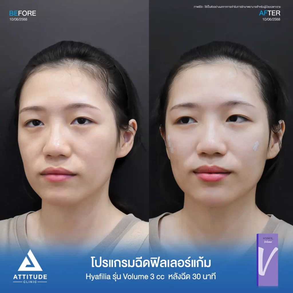 รีวิวโปรแกรมฉีดฟิลเลอร์แก้มพี่แพร Hya รุ่น V จำนวน 3 cc หลังทำ 30 นาที เติมเต็มแก้มตก แก้มยุบให้อิ่มฟู ดูสดใสขึ้นที่ ATTITUDE CLINIC