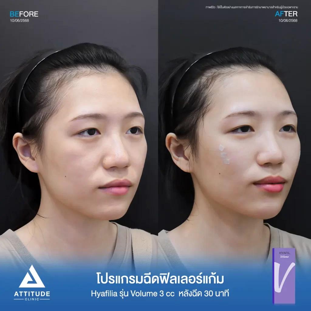 รีวิวโปรแกรมฉีดฟิลเลอร์แก้มพี่แพร Hya รุ่น V จำนวน 3 cc หลังทำ 30 นาที เติมเต็มแก้มตก แก้มยุบให้อิ่มฟู ดูสดใสขึ้นที่ ATTITUDE CLINIC