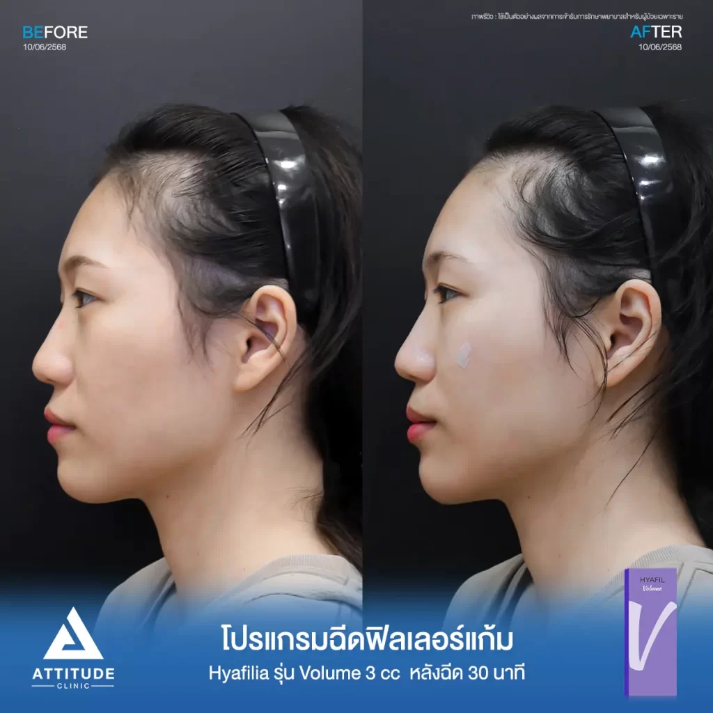 รีวิวโปรแกรมฉีดฟิลเลอร์แก้มพี่แพร Hya รุ่น V จำนวน 3 cc หลังทำ 30 นาที เติมเต็มแก้มตก แก้มยุบให้อิ่มฟู ดูสดใสขึ้นที่ ATTITUDE CLINIC