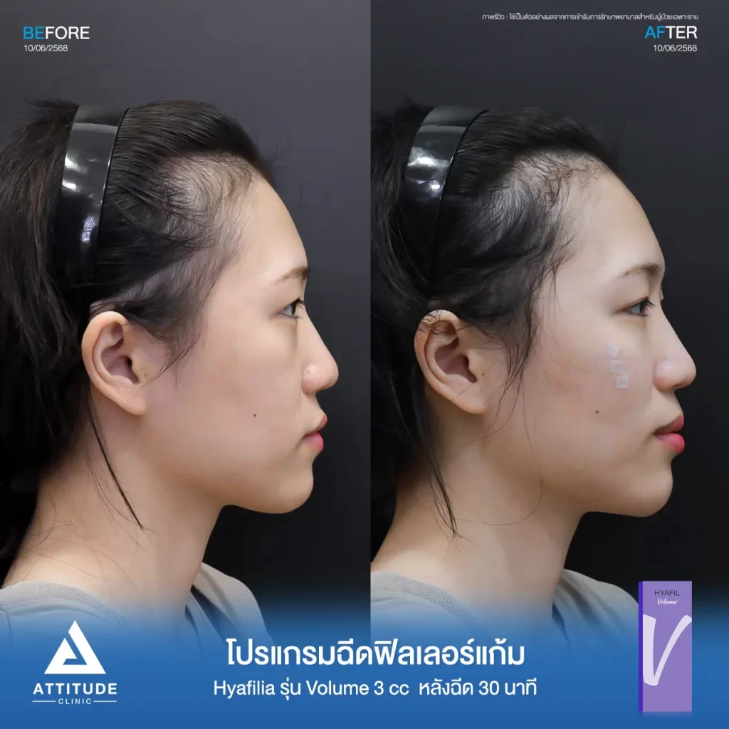 รีวิวโปรแกรมฉีดฟิลเลอร์แก้มพี่แพร Hya รุ่น V จำนวน 3 cc หลังทำ 30 นาที เติมเต็มแก้มตก แก้มยุบให้อิ่มฟู ดูสดใสขึ้นที่ ATTITUDE CLINIC