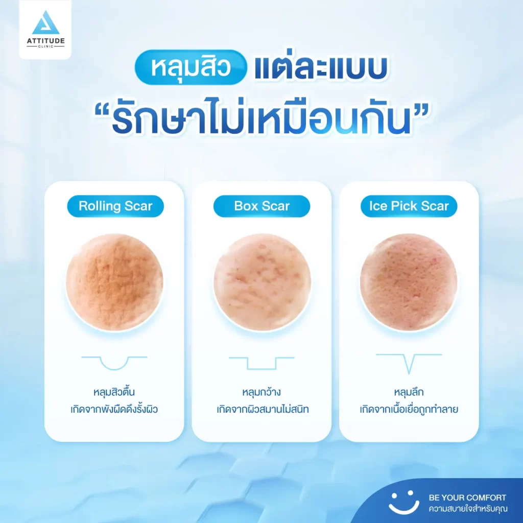 หลุมสิว ใครว่ารักษาเหมือนกัน! บางคนรักษาด้วยเทคโนโลยี Microneedle RF หลายครั้ง แต่หลุมสิวยังอยู่ เพราะอะไรกันแน่​ ?