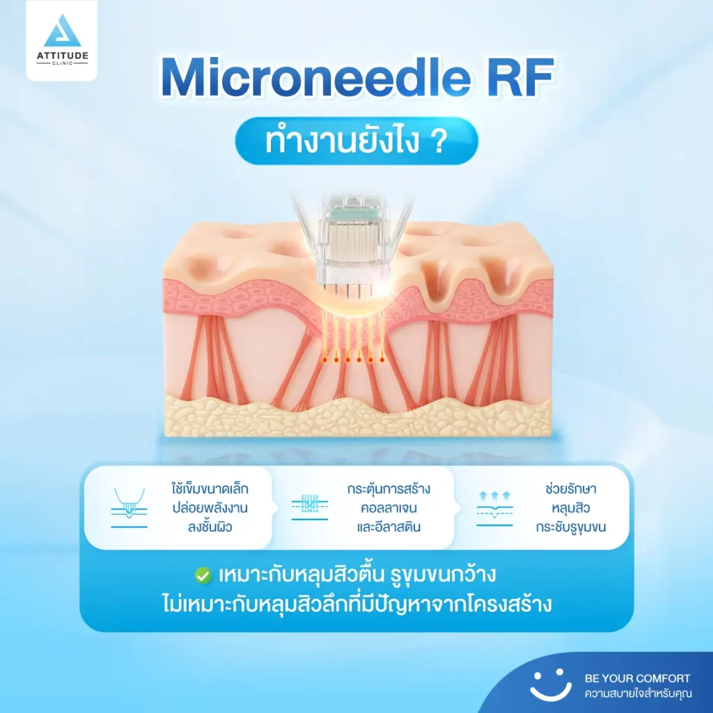 หลุมสิว ใครว่ารักษาเหมือนกัน! บางคนรักษาด้วยเทคโนโลยี Microneedle RF หลายครั้ง แต่หลุมสิวยังอยู่ เพราะอะไรกันแน่​ ?