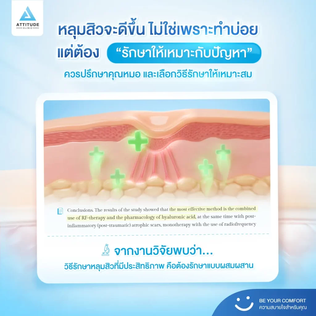หลุมสิว ใครว่ารักษาเหมือนกัน! บางคนรักษาด้วยเทคโนโลยี Microneedle RF หลายครั้ง แต่หลุมสิวยังอยู่ เพราะอะไรกันแน่​ ?