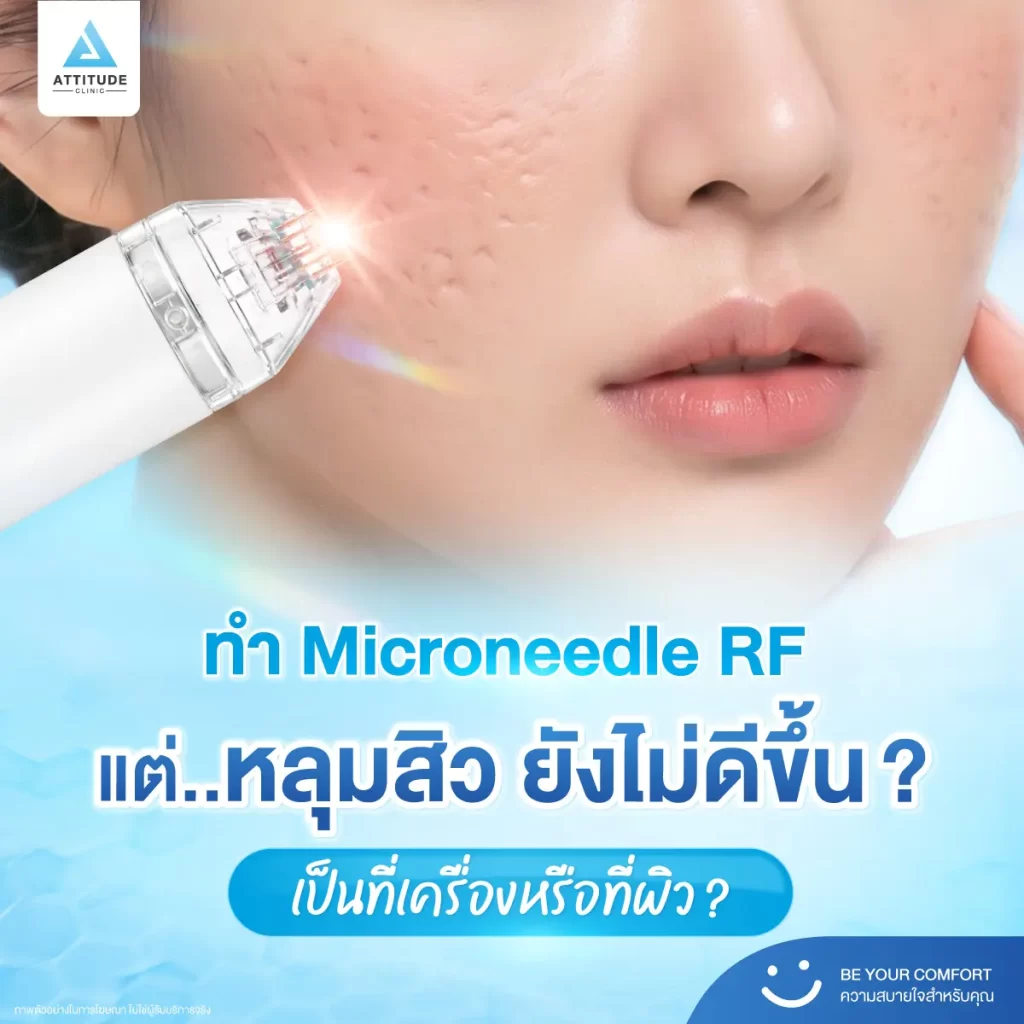 หลุมสิว ใครว่ารักษาเหมือนกัน! บางคนรักษาด้วยเทคโนโลยี Microneedle RF หลายครั้ง แต่หลุมสิวยังอยู่ เพราะอะไรกันแน่​ ?