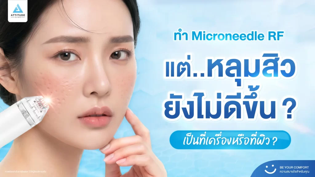 หลุมสิว ใครว่ารักษาเหมือนกัน! บางคนรักษาด้วยเทคโนโลยี Microneedle RF หลายครั้ง แต่หลุมสิวยังอยู่ เพราะอะไรกันแน่​ ?