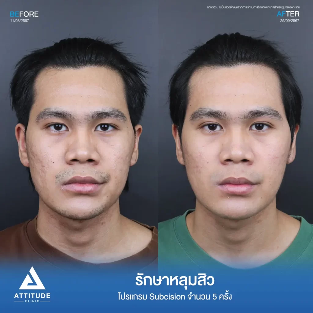 รีวิวรักษาหลุมสิวพี่ชิติพัทธ์ ด้วยโปรแกรม Subcision จำนวน 5 ครั้ง หลุมสิวตื้นขึ้น ผิวหน้าเรียบเนียนขึ้นที่ Attitude Clinic