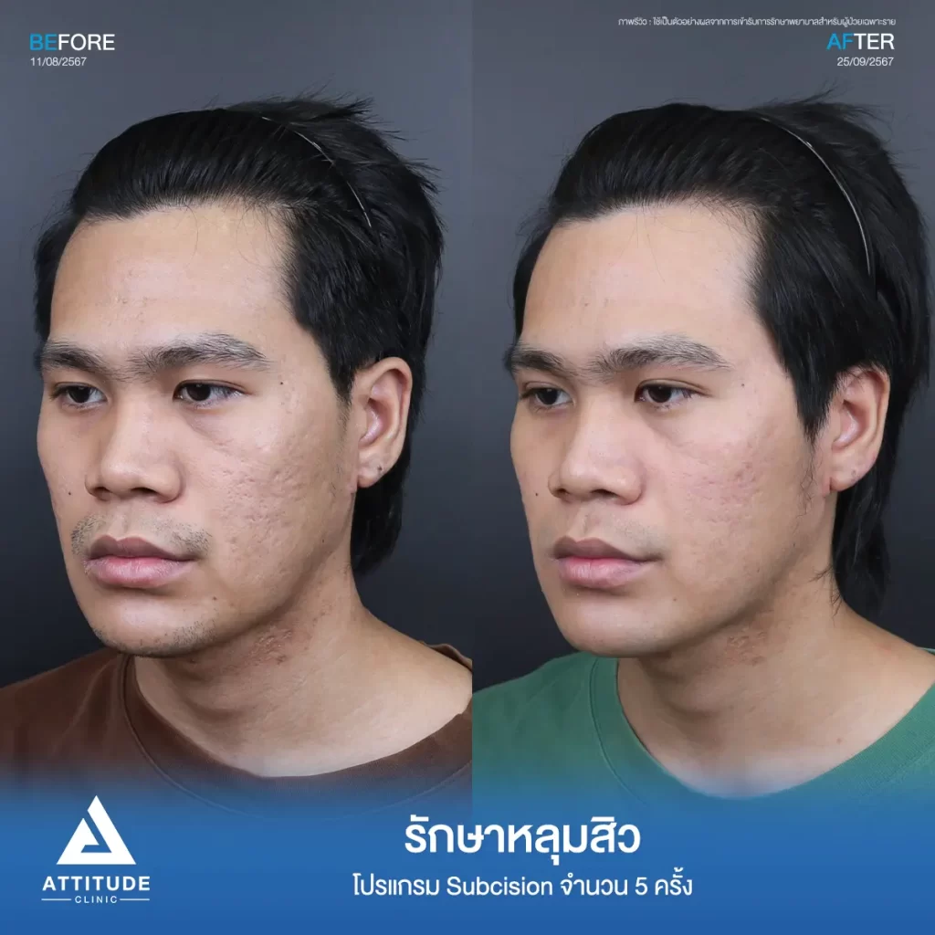 รีวิวรักษาหลุมสิวพี่ชิติพัทธ์ ด้วยโปรแกรม Subcision จำนวน 5 ครั้ง หลุมสิวตื้นขึ้น ผิวหน้าเรียบเนียนขึ้นที่ Attitude Clinic