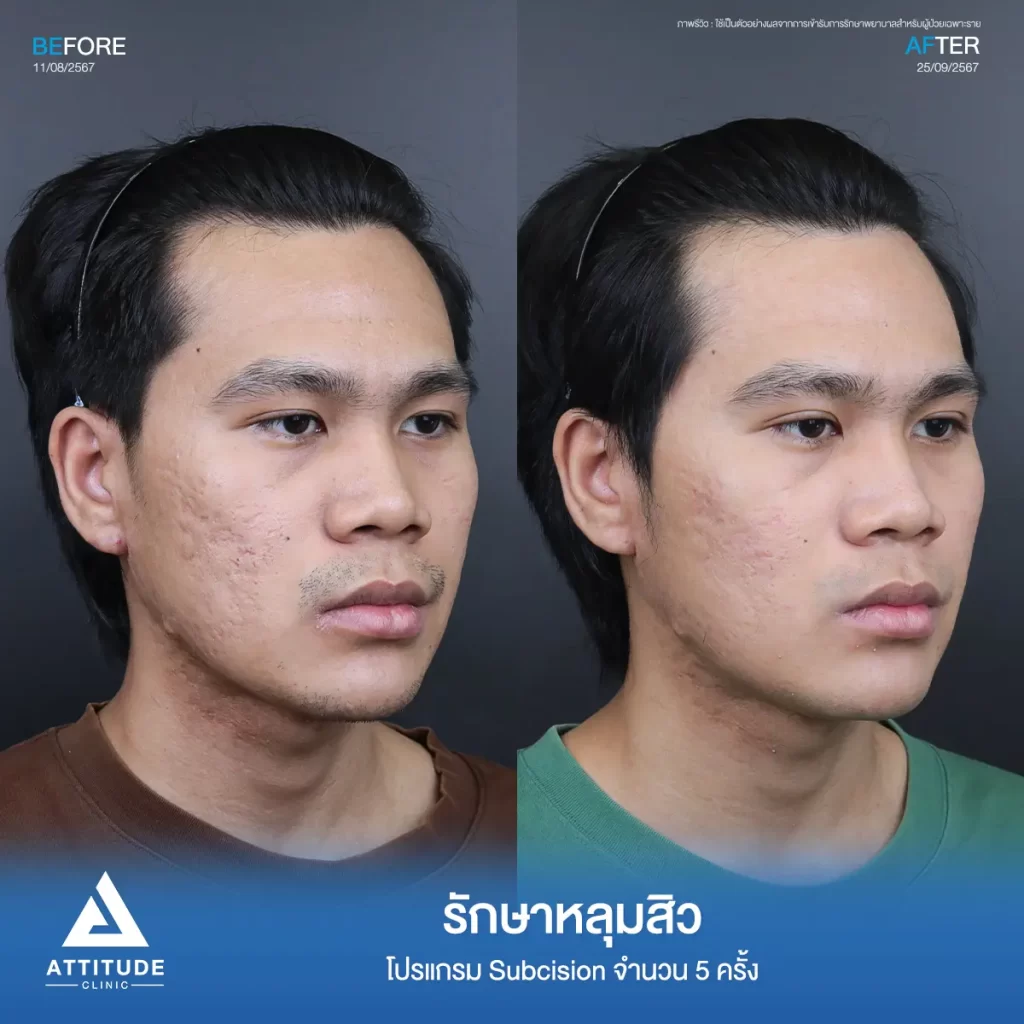 รีวิวรักษาหลุมสิวพี่ชิติพัทธ์ ด้วยโปรแกรม Subcision จำนวน 5 ครั้ง หลุมสิวตื้นขึ้น ผิวหน้าเรียบเนียนขึ้นที่ Attitude Clinic