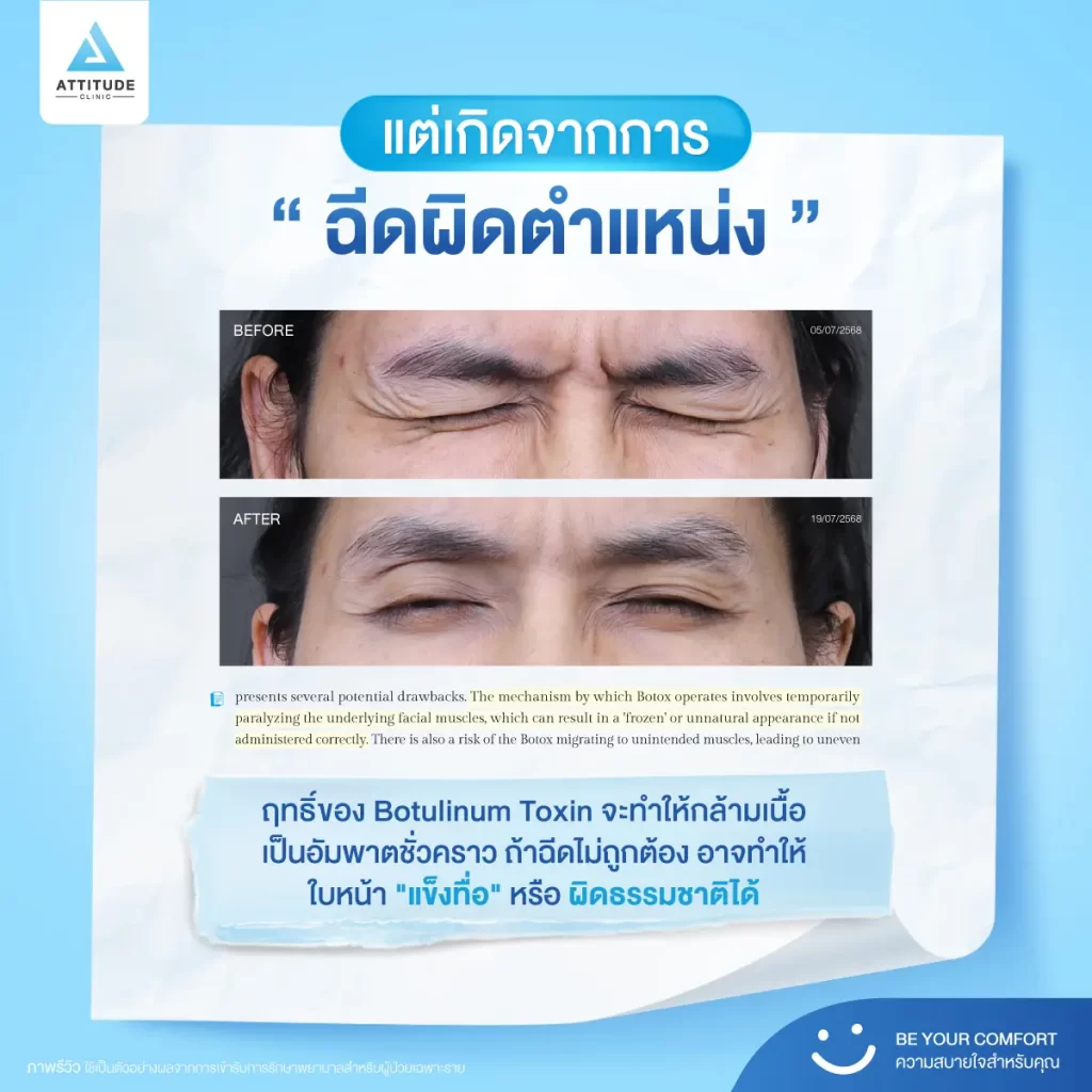 โปรแกรมฉีดโบท็อกซ์ จิ้มแล้วหน้าแข็ง หน้าตึง อาจไม่ได้เกิดจากตัวยา!