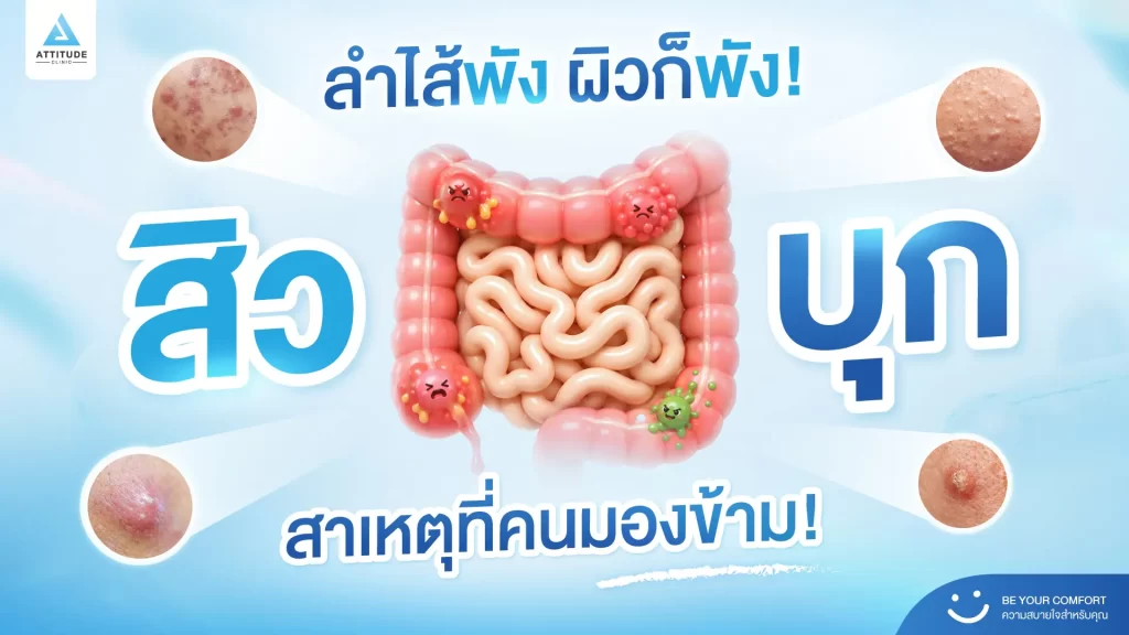 หยุดวงจรสิว แบบไม่ต้องจ่ายแพง เริ่มง่าย ๆ แค่ดูแลลำไส้