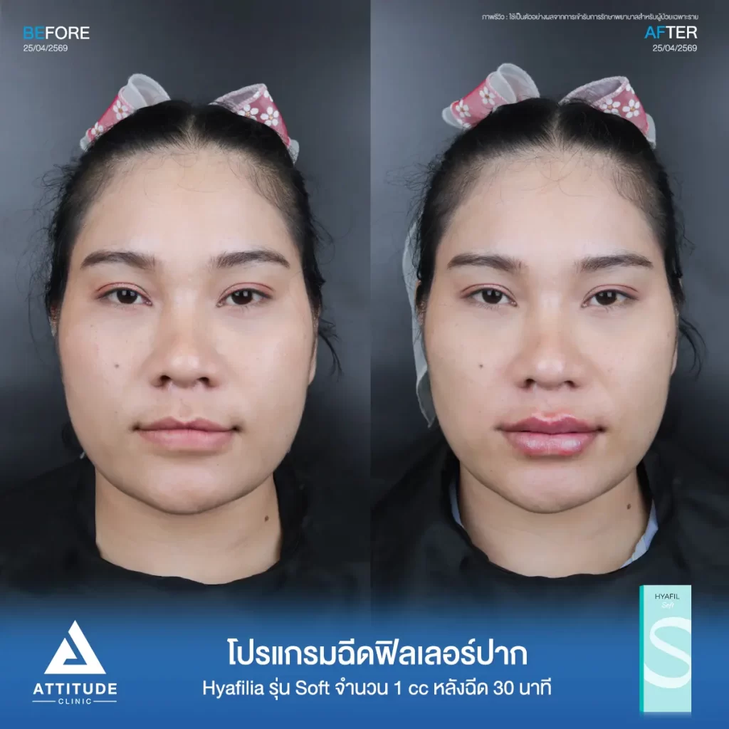 รีวิวโปรแกรมฉีดฟิลเลอร์ปากพี่กี้ Hya รุ่น Soft จำนวน 1 cc หลังทำ 30 นาที เติมเต็มปากให้อวบอิ่ม เป็นทรงสวยถูกใจที่ ATTITUDE CLINIC