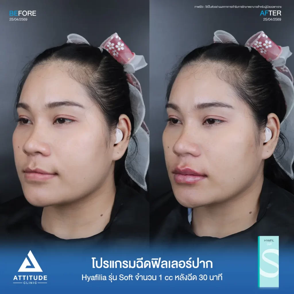 รีวิวโปรแกรมฉีดฟิลเลอร์ปากพี่กี้ Hya รุ่น Soft จำนวน 1 cc หลังทำ 30 นาที เติมเต็มปากให้อวบอิ่ม เป็นทรงสวยถูกใจที่ ATTITUDE CLINIC