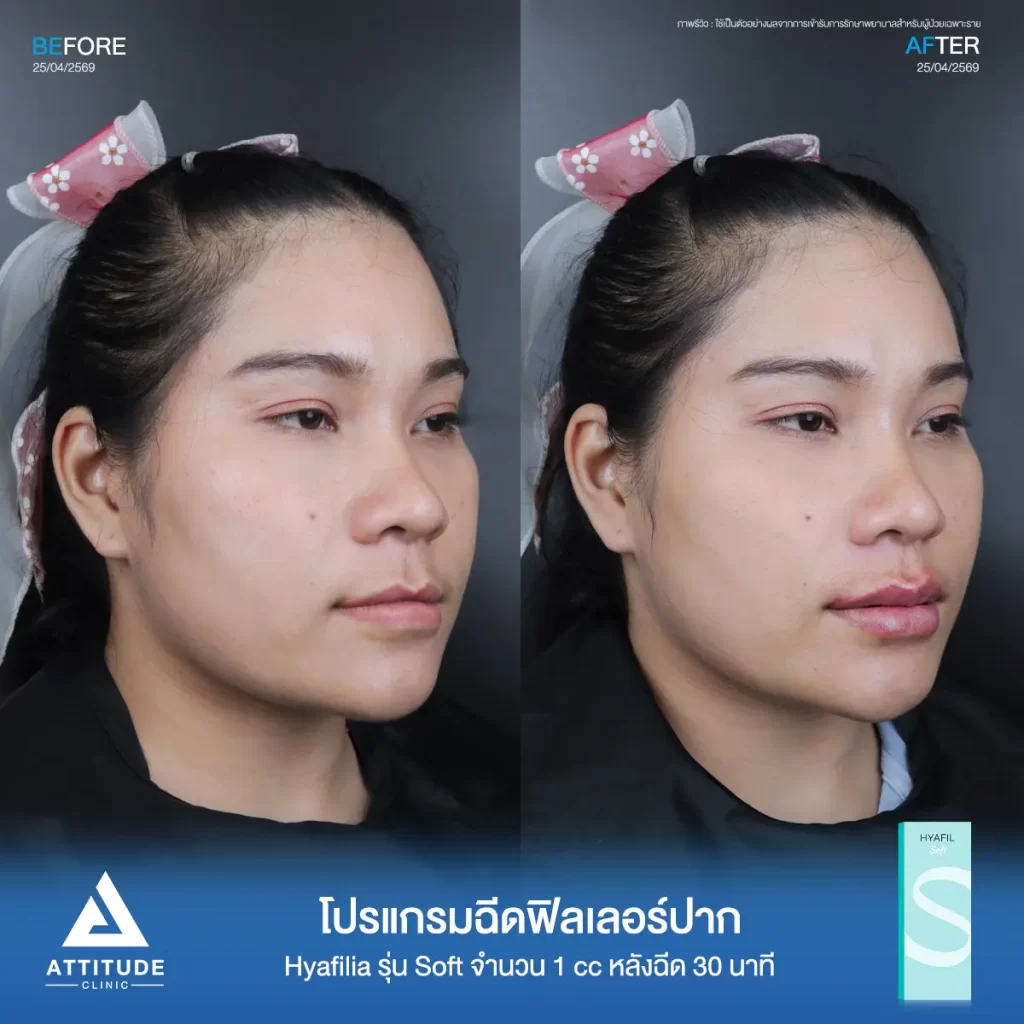 รีวิวโปรแกรมฉีดฟิลเลอร์ปากพี่กี้ Hya รุ่น Soft จำนวน 1 cc หลังทำ 30 นาที เติมเต็มปากให้อวบอิ่ม เป็นทรงสวยถูกใจที่ ATTITUDE CLINIC