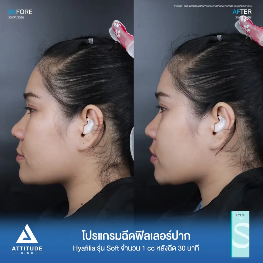 รีวิวโปรแกรมฉีดฟิลเลอร์ปากพี่กี้ Hya รุ่น Soft จำนวน 1 cc หลังทำ 30 นาที เติมเต็มปากให้อวบอิ่ม เป็นทรงสวยถูกใจที่ ATTITUDE CLINIC