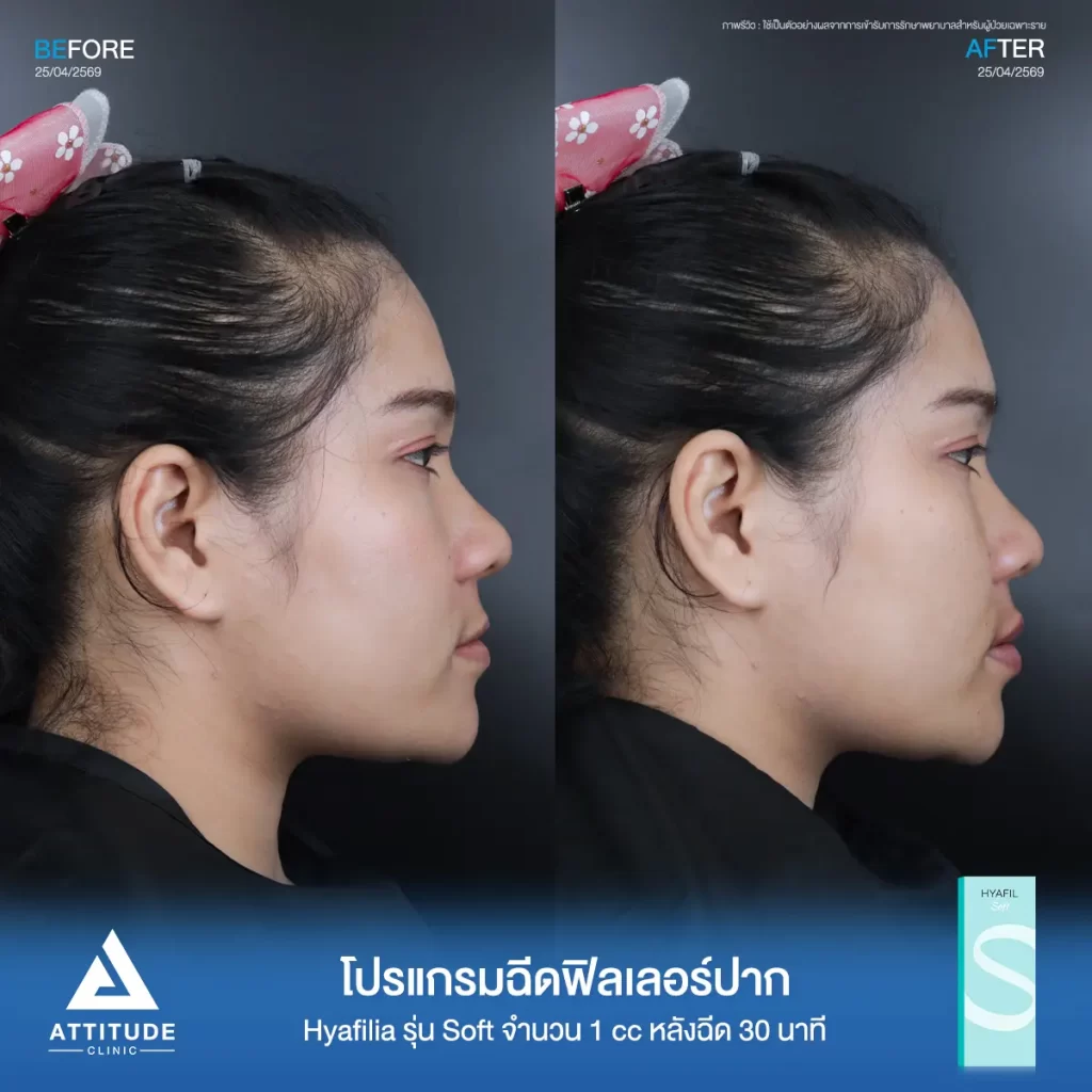 รีวิวโปรแกรมฉีดฟิลเลอร์ปากพี่กี้ Hya รุ่น Soft จำนวน 1 cc หลังทำ 30 นาที เติมเต็มปากให้อวบอิ่ม เป็นทรงสวยถูกใจที่ ATTITUDE CLINIC