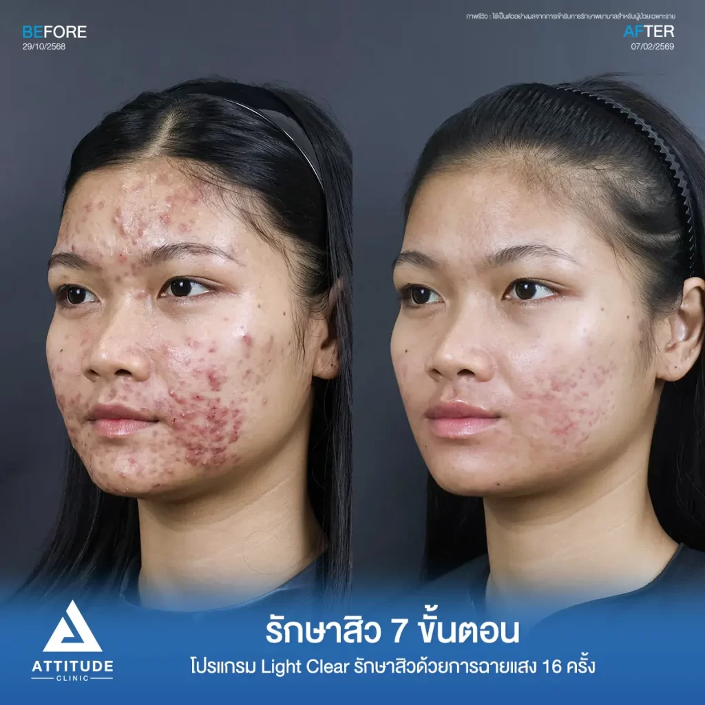 รีวิวรักษาสิวพี่หมิว โปรแกรม Light Clear รักษาสิวด้วยการฉายแสง จำนวน 16 ครั้งที่ Attitude Clinic