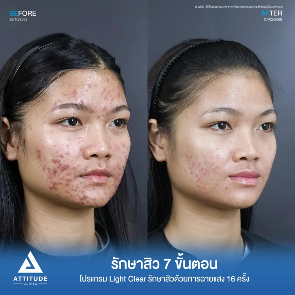 รีวิวรักษาสิวพี่หมิว โปรแกรม Light Clear รักษาสิวด้วยการฉายแสง จำนวน 16 ครั้งที่ Attitude Clinic