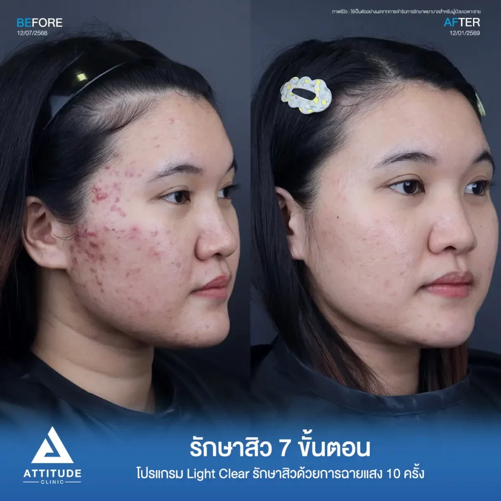 รีวิวรักษาสิวพี่พิมพ์ โปรแกรม Light Clear รักษาสิวด้วยการฉายแสง จำนวน 10 ครั้งที่ Attitude Clinic