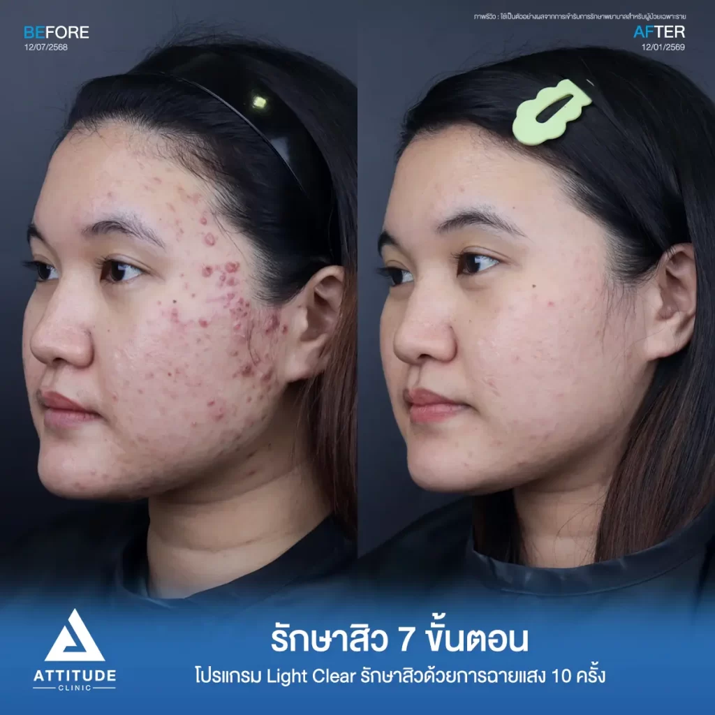 รีวิวรักษาสิวพี่พิมพ์ โปรแกรม Light Clear รักษาสิวด้วยการฉายแสง จำนวน 10 ครั้งที่ Attitude Clinic