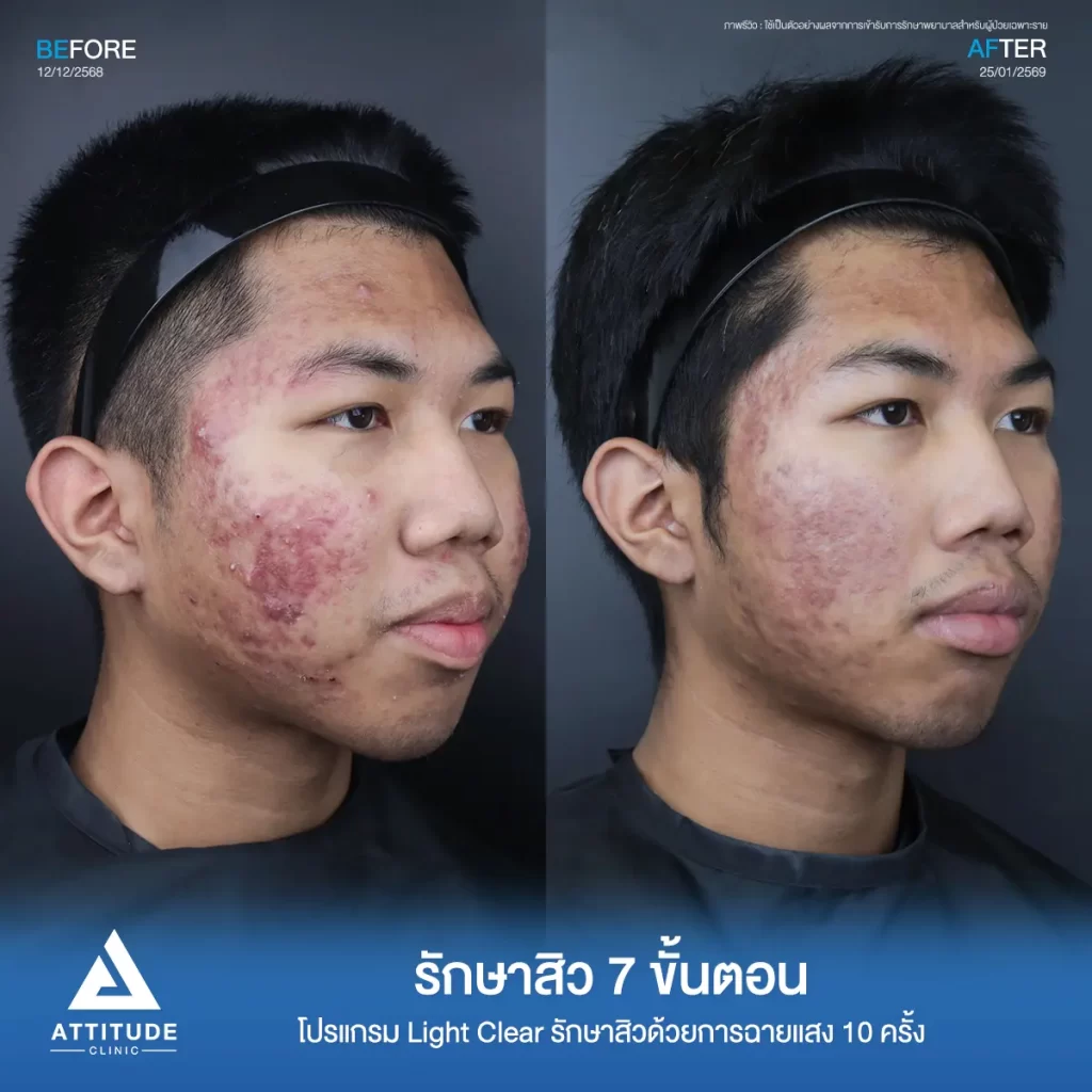 รีวิวรักษาสิวพี่เชน โปรแกรม Light Clear รักษาสิวด้วยการฉายแสง จำนวน 10 ครั้งที่ Attitude Clinic