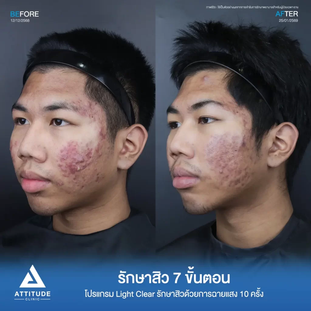 รีวิวรักษาสิวพี่เชน โปรแกรม Light Clear รักษาสิวด้วยการฉายแสง จำนวน 10 ครั้งที่ Attitude Clinic