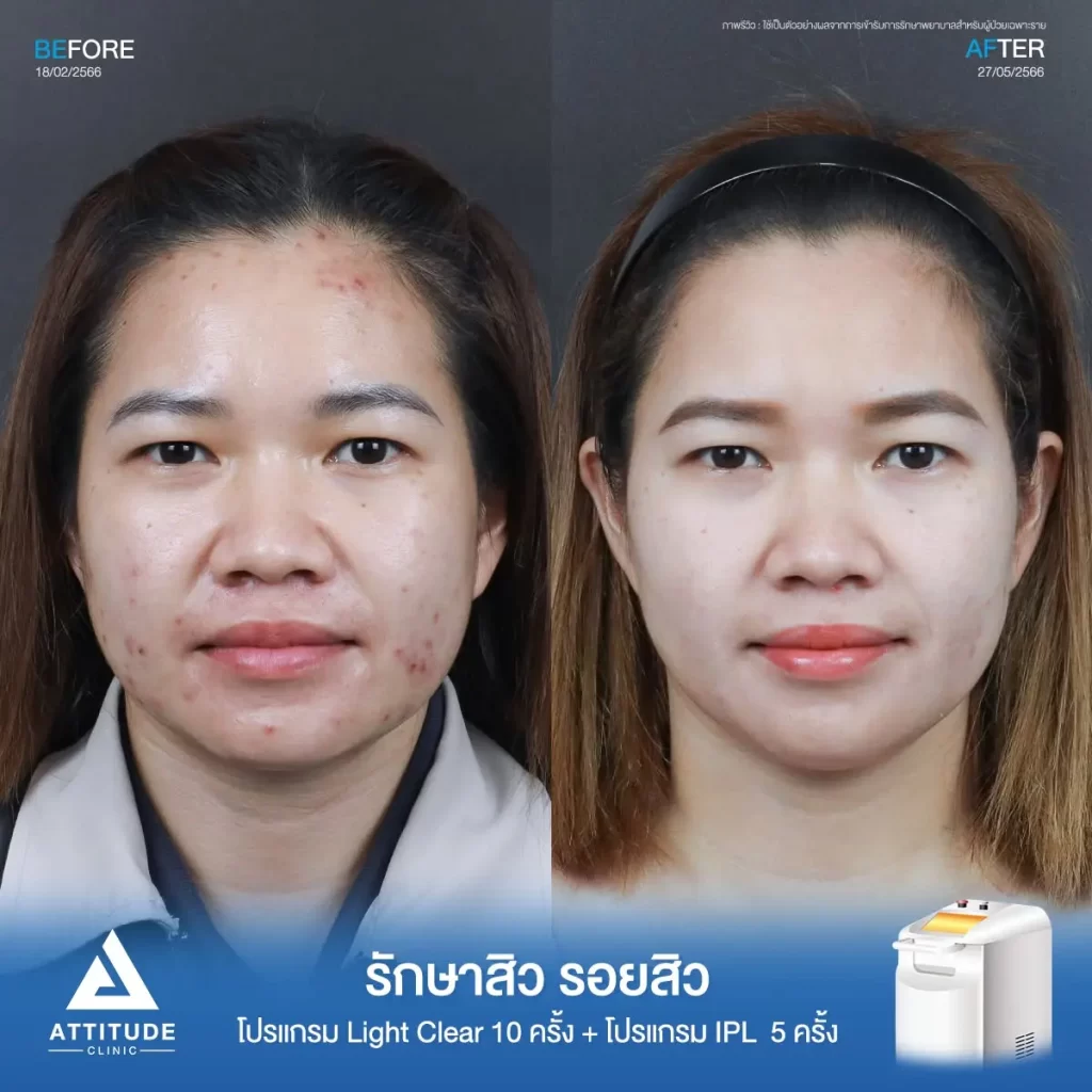 รีวิวรักษาสิว รอยสิวพี่ก้อย ด้วยโปรแกรม Light Clear จำนวน 10 ครั้ง และโปรแกรม IPL จำนวน 5 ครั้ง ที่ Attitude Clinic