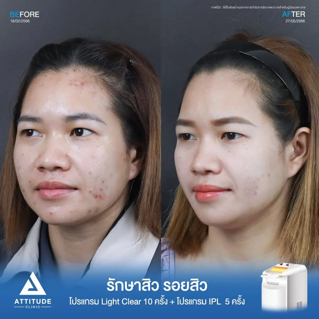 รีวิวรักษาสิว รอยสิวพี่ก้อย ด้วยโปรแกรม Light Clear จำนวน 10 ครั้ง และโปรแกรม IPL จำนวน 5 ครั้ง ที่ Attitude Clinic