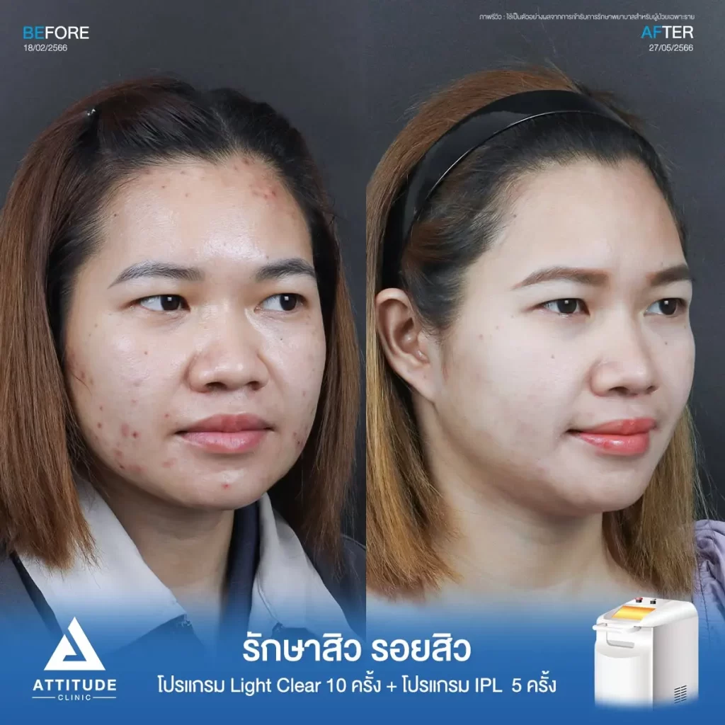 รีวิวรักษาสิว รอยสิวพี่ก้อย ด้วยโปรแกรม Light Clear จำนวน 10 ครั้ง และโปรแกรม IPL จำนวน 5 ครั้ง ที่ Attitude Clinic