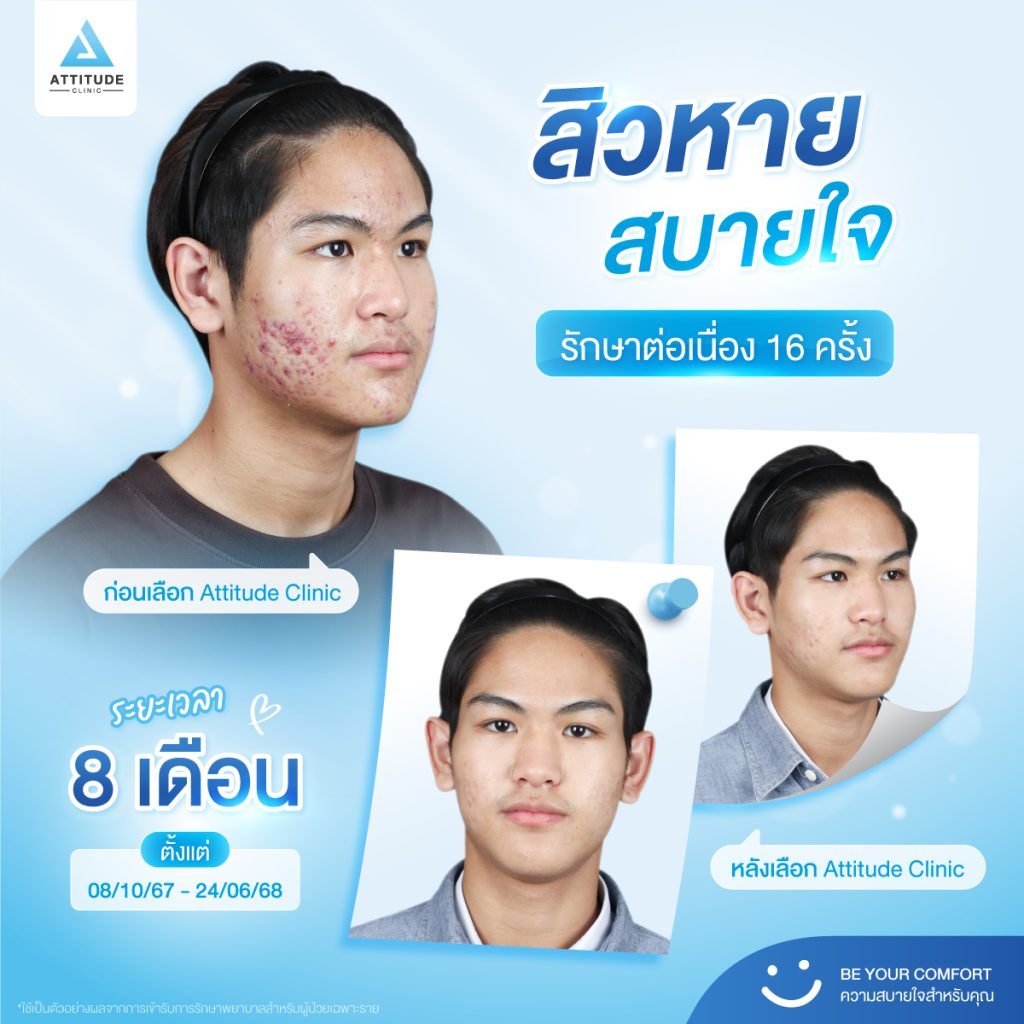 รักษาสิว