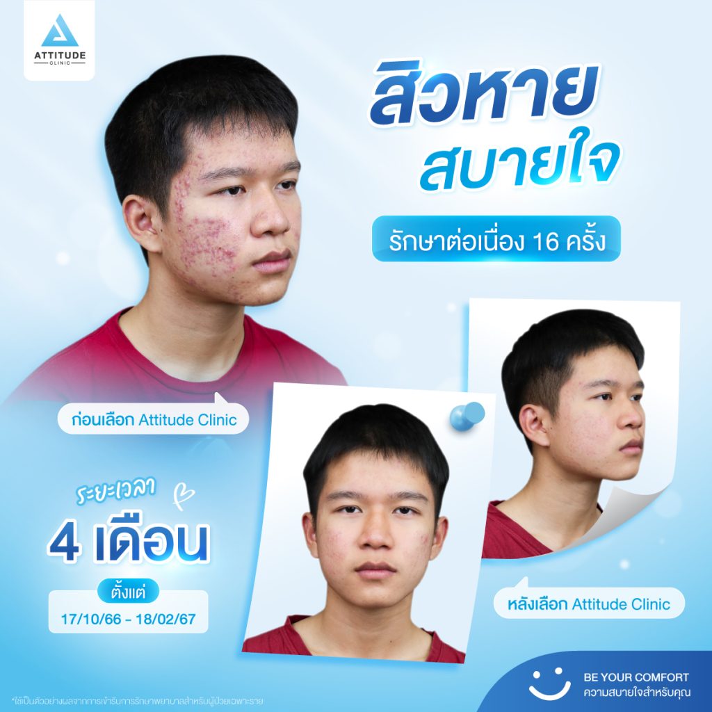 รักษาสิว