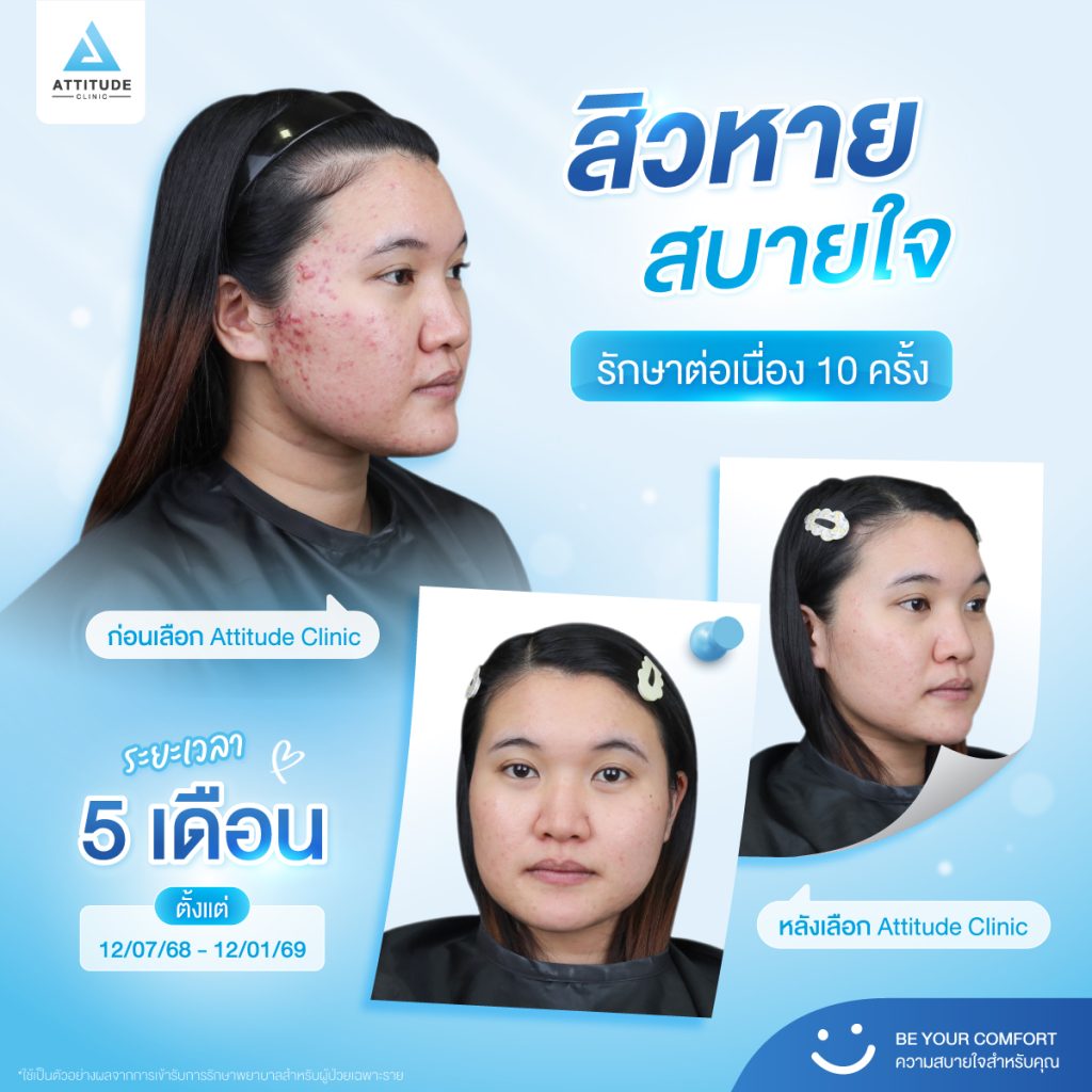 รักษาสิว