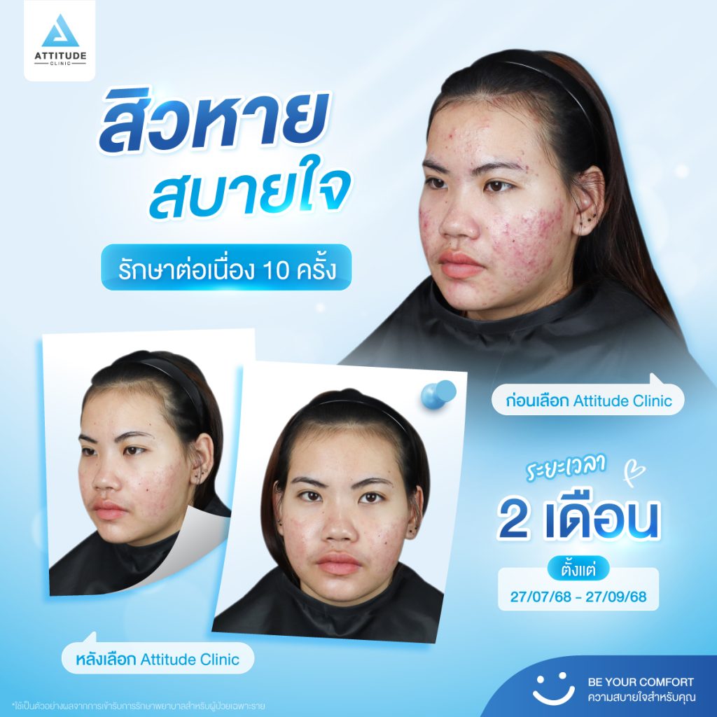 รักษาสิว